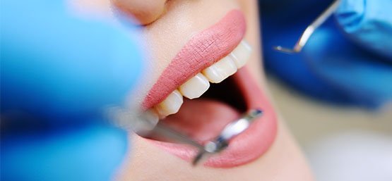 advantage-of-tooth-coloured-fillings-leichhardt