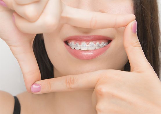 benefits-of-orthodontics-leichhardt