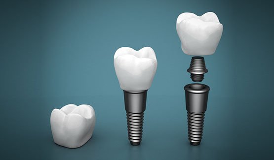 dental-implants-leichhardt