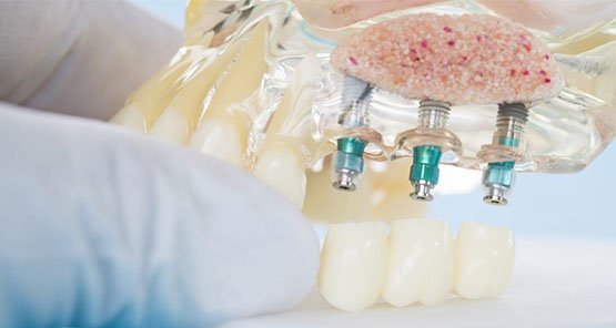 dental-implants-service-blurb-leichhardt