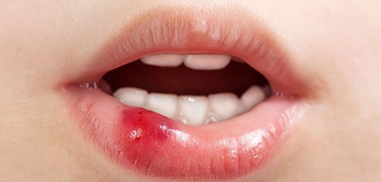 soft-tissues-injuries-in-the-mouth-leichhardt