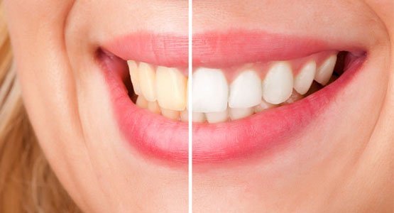 teeth-whitening-leichhardt-banner