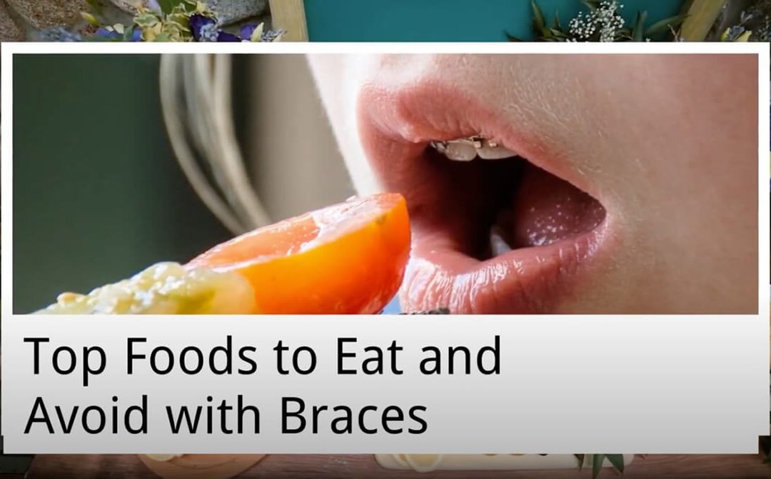 Top Foods to Eat and Avoid with Braces from My Local Dentists (previously Leichhardt Marketplace Dental)